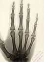 Radiographie d'une main par le docteur Houllier au début du XXe siècle - Toute utilisation et droit réservés par © Photothèque Ducatez